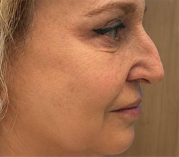 Лицо до омолаживающей процедуры